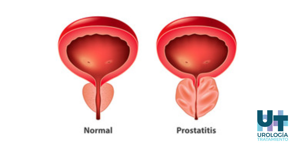sintomas-prostatitis