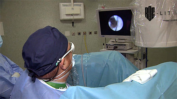 litiasis ureteral ureterorrenoscopia